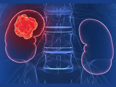 bobrek-kanseri bobrek-kanseri