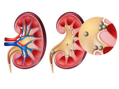 bobrek-tasi bobrek-tasi