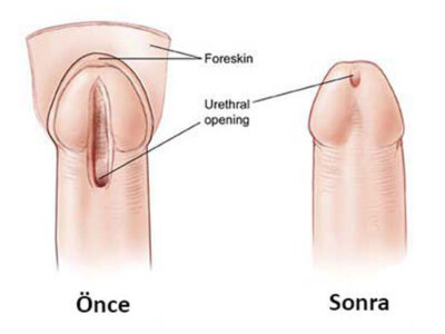 hipospadias hipospadias