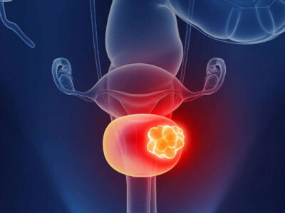 mesane-kanseri mesane-kanseri