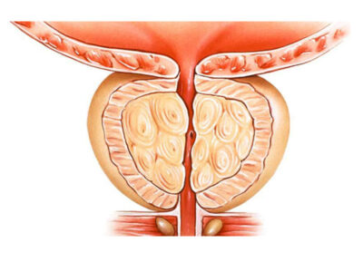 prostat-buyumesi prostat-buyumesi