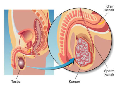 testis-kanseri testis-kanseri