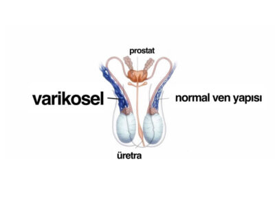 varikosel varikosel